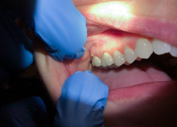 Best Emergency Care for Gum Disease in Phelan, CA