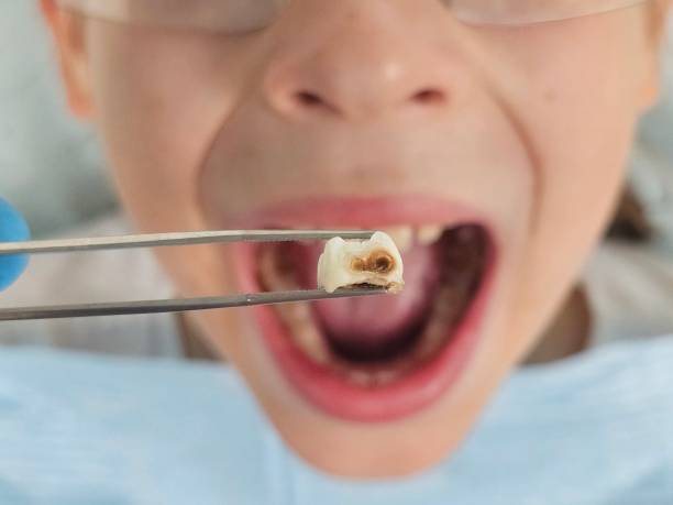 Best Emergency Treatment for Oral Infections in Phelan, CA